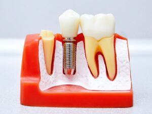 Dental Implant Treatment in Hinjawadi