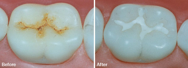 pit and fissure sealants