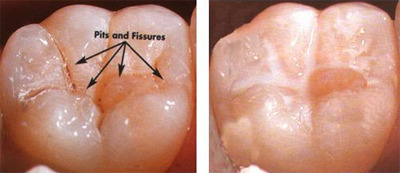 pit-fissure-sealants 2